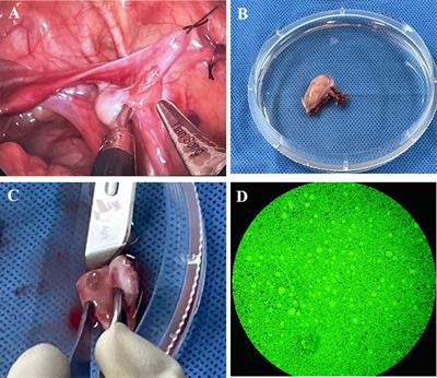 Ovarian tissue cryopreservation for a 3-year-old girl with Mosaic Turner syndrome in China: First case report and literature review